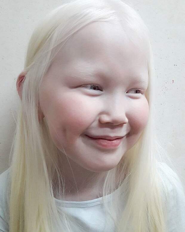 Как выглядят альбиносы разных рас 