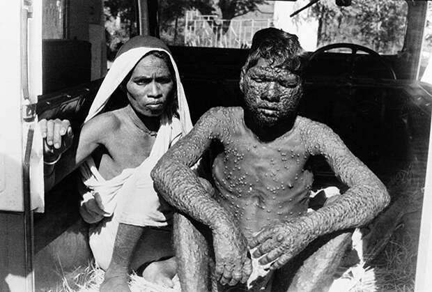 Больные натуральной оспой. Индия, 1974 год 