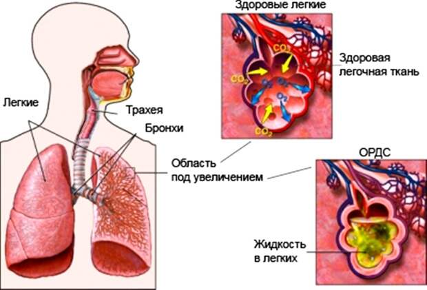 Альвеолярный отек легких: симптомы, причины, лечение, неотложная помощь