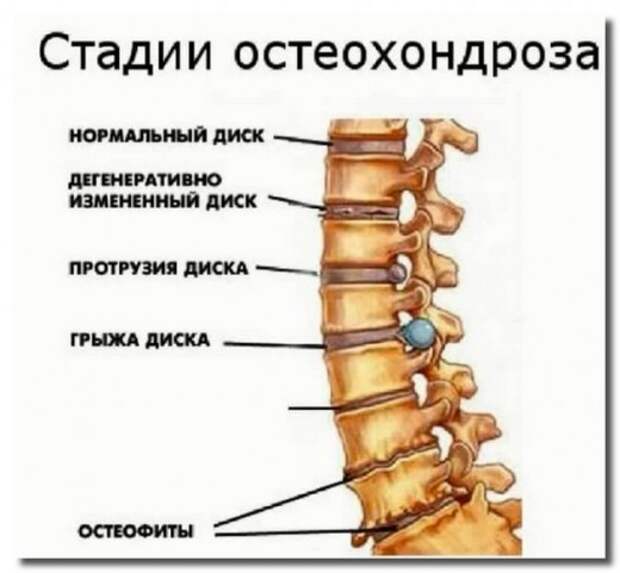СОВЕТЫ ПРИ БОЛЯХ В СПИНЕ