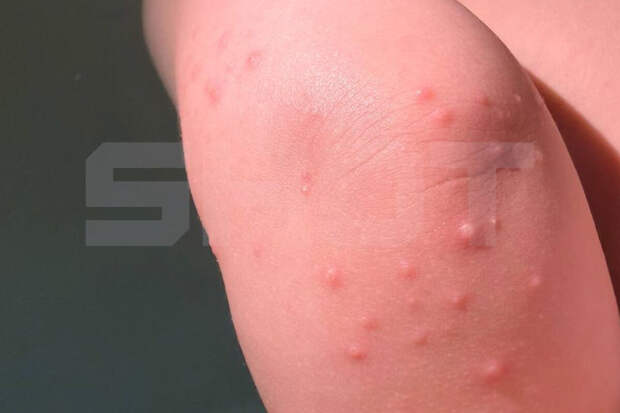 Врач Компанец: инфекция среди детей туристов в Таиланде похожа на энтеровирус