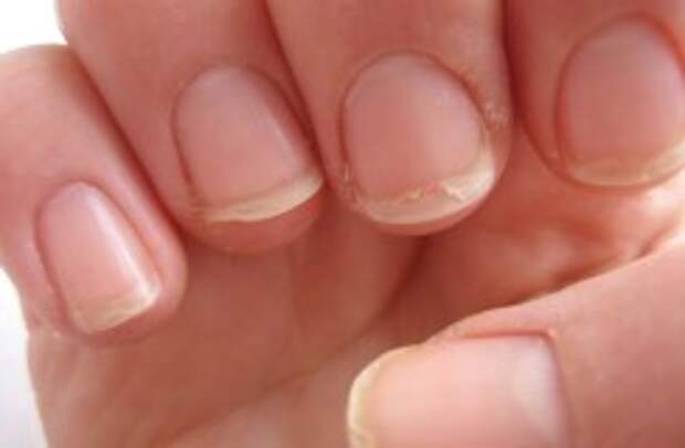 Плохое состояние ногтей из-за недостатка витаминов