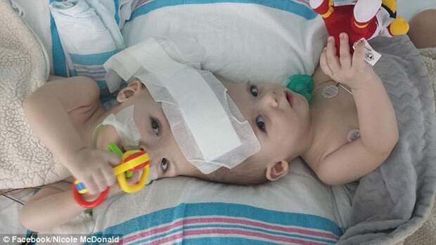 Первые фотографии сиамских близнецов после разделения медицина, сиамские близнецы, хирургия