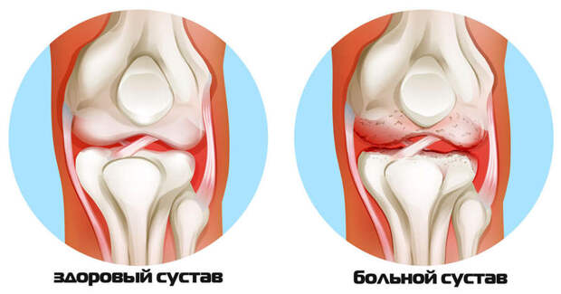 Что делать при артритах и артрозах: ЗОЛОТЫЕ СОВЕТЫ восточной медицины