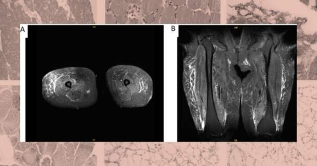 Однократный семаглутид связали с иммуноопосредованной некротизирующей миопатией у пожилой женщины