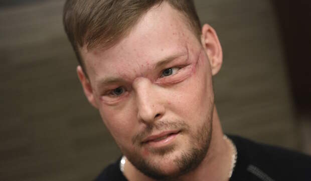 Невероятные результаты пересадки лица, сделанной парню после того, как он выстрелил себе в лицо лицо, люди, медицина, операция