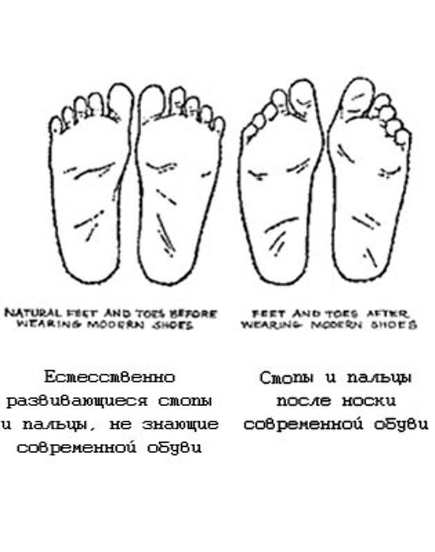 Как не искалечить детскую ногу