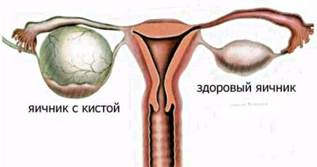 Основная причина гинекологических заболеваний у женщин
