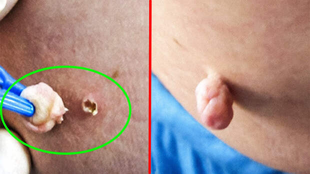 5 народных способов удаления папилломы