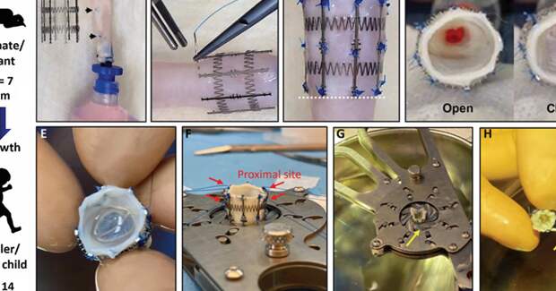 Уникальный клапан для растущих сердец: искусственная «пружина» меняет размер вместе с ребенком