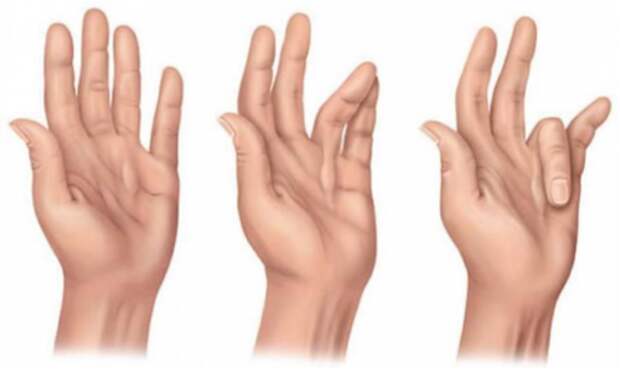 Ударно-волновая терапия как метод лечения контрактуры Дюпюитрена