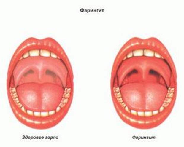 Хронический фарингит: симптомы, причины заболевание, лечение Одним из наиболее распространённых на сегодняшний день заболеваний горла является хронический фарингит.