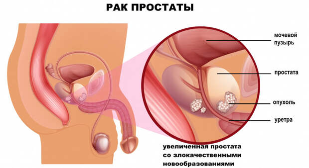Ранний рак простаты обычно не вызывает никаких симптомов, но может включать кровь в моче или сперме.