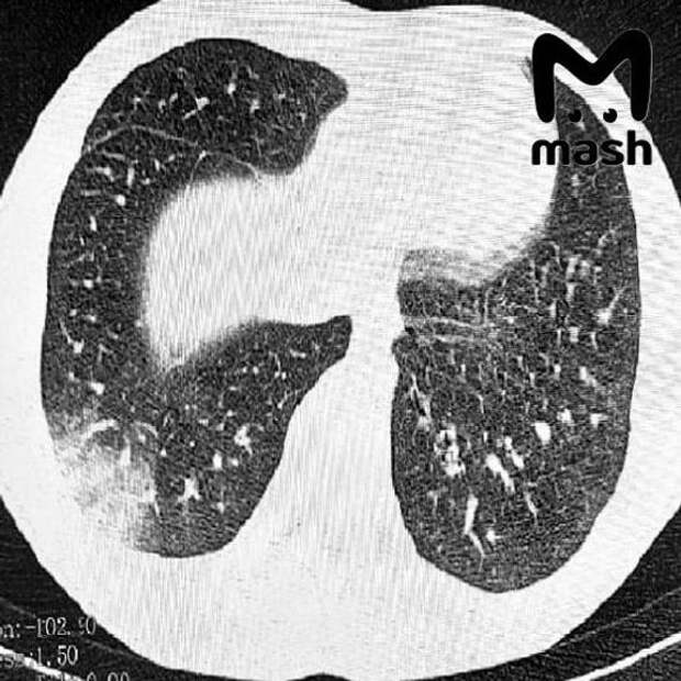 Троих зумеров экстренно доставили в реанимацию Ростовской области с попкорновой болезнью лёгких — которая развилась из-за постоянного курения вейпов