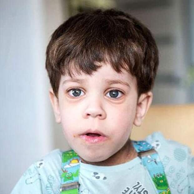Тимофей Наумушкин, 3 года, тяжелая форма врожденной инсулинорезистентности – синдром Донохью, спасет лекарство, 623 768 ₽