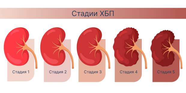 Эта болезнь есть у каждого восьмого. Возможно вы уже больны, но об этом не знаете