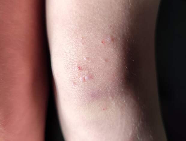 Россиян предупредили о риске заразиться коварной инфекцией в общественных местах