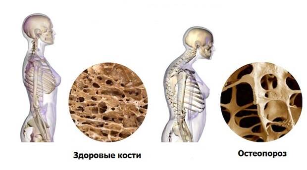 Как поддерживать плотность костей после 60 лет: практическое руководство для мужчин и женщин