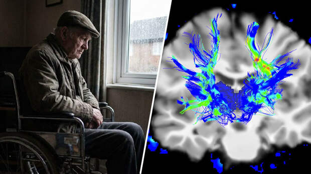 «Способны повреждать нервные клетки»: эксперты — о главных факторах развития болезни Паркинсона