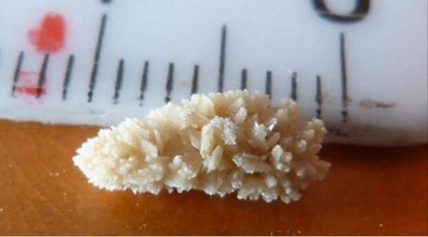 how-to-break-down-kidney-stones-and-kill-bladder-infection-with-this-one-ingredient-juice-600x332