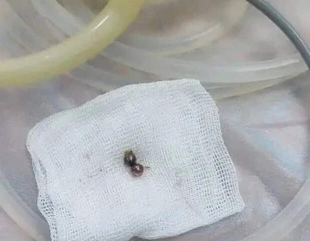 Севастопольские хирурги спасли ребёнка, который проглотил магнитные шарики