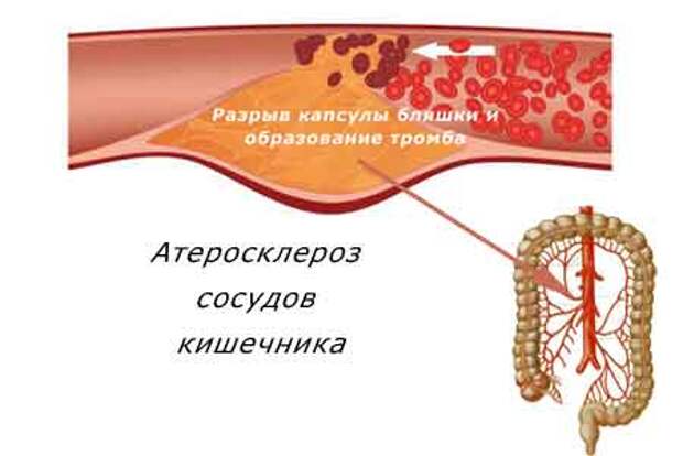 атеросклероз артерий кишечника