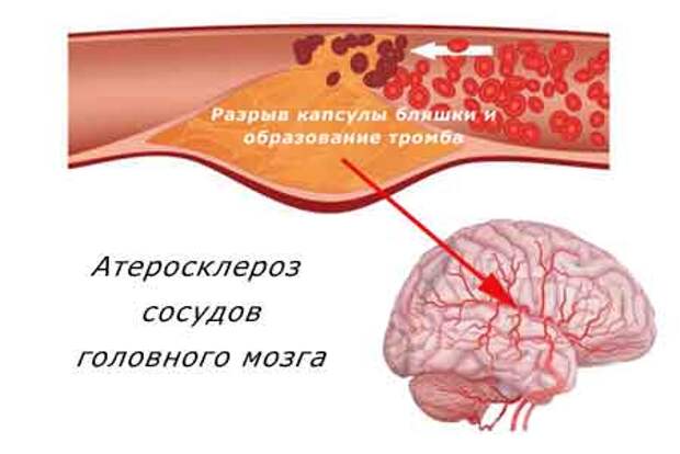 атеросклероз сосудов головного мозга