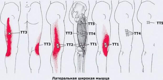 Триггерные точки на теле человека фото с описанием для снятия боли в бедре