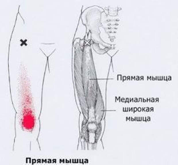 Триггерные точки на теле человека фото с описанием для снятия боли в бедре