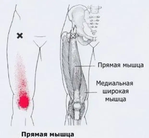 Карта точек боли в теле и точек напряжения мышц триггеры