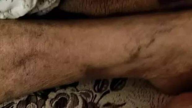 Напомним, дочь 90-летней жительницы рассказала, что медперсонал ГБУЗ СК «ГКБ № 2» истязал ее мать. На теле у пожилой женщины родственники обнаружили многочисленные синяки и гематомы. Кроме того, со слов близких, старушку привязывали к кровати и не давали есть и пить. Инцидент произошел в марте этого года. Тогда в больнице заверили, что огромный синяк на пол-лица появился из-за того, что женщина потянулась за водой и ударилась о тумбочку.