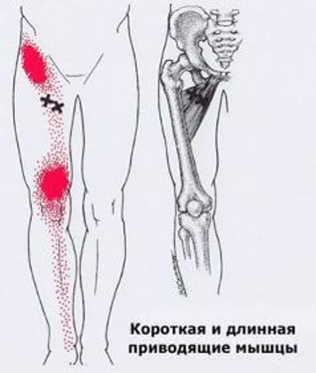 Триггерные точки на теле человека фото с описанием для снятия боли в бедре