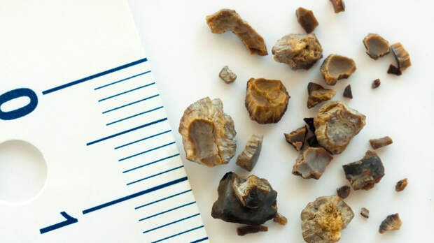 Уролог Сыркин: камни в почках могут вызвать серьёзные осложнения