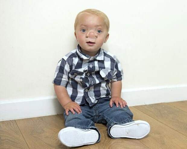 Реальный Пиноккио: мальчик родился с частью мозга в носу Реальный Пиноккио, мальчик, нос