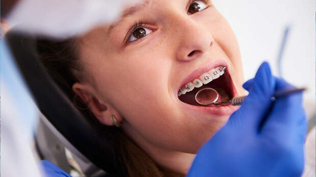 Врач предупредила о последствиях неправильно установленных брекетов
