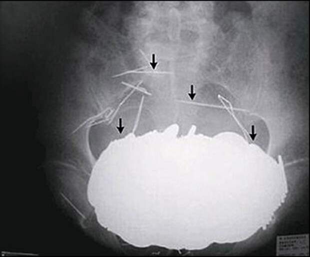 stuffinside04 Самые невероятные предметы, которые были найдены в человеческом теле