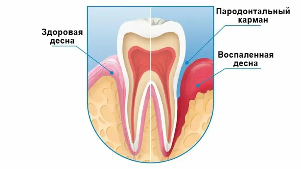 Злейший враг вашей десны — зубочистка