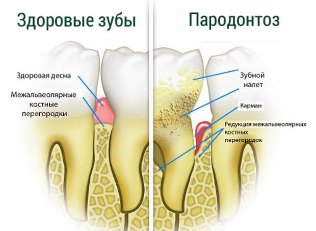 пародонтоз