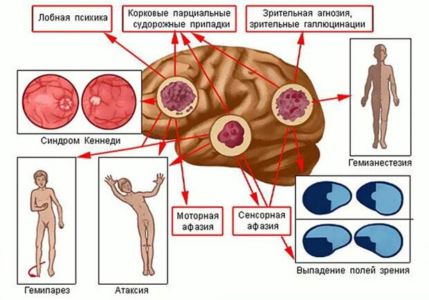 Опухоли мозга