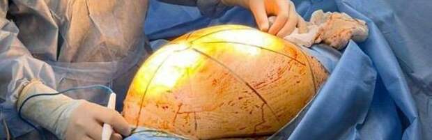 В Алматы врачи удалили пациентке 25-килограммовую опухоль