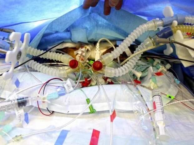 bern-university-hospital-conjoined-twins-operation