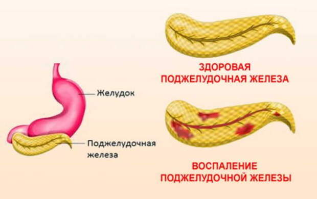 Случай излечения воспаления поджелудочной железы при помощи бархатцев и золотого уса