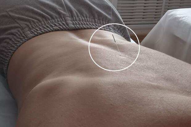 Судмедэксперт Решетун: иглоукалывание работает на уровне самовнушения