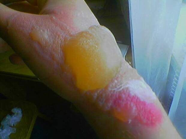 Если сок борщевика брызнул очень обильно, то на коже образуются волдыри, наполненные жидкостью. Фото: ОЦСП Фейсбук