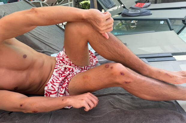 Певец Хабиб получил 21 ссадину после падения с мотоцикла