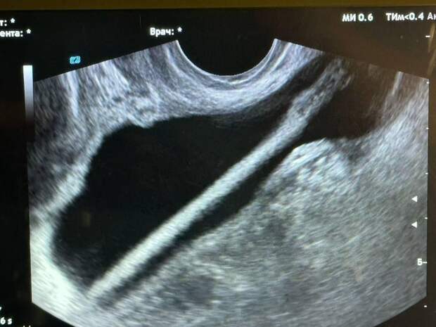 Врачи достали косметический карандаш из мочевого пузыря пациентки