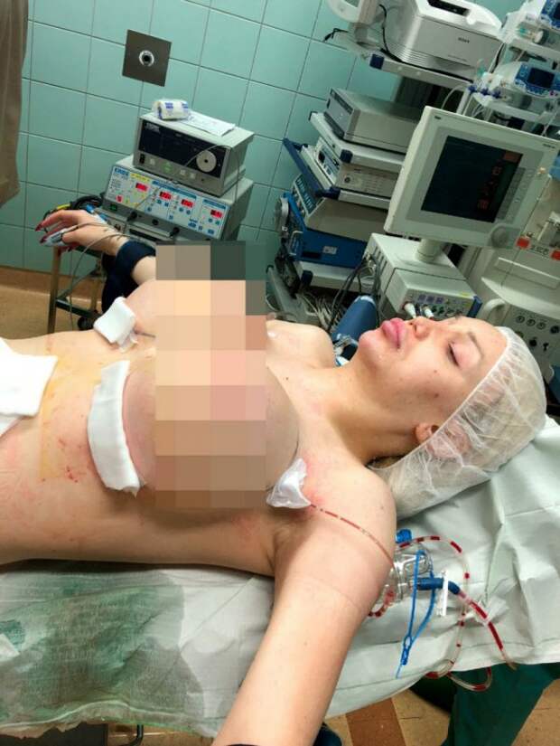 Трансгендерная женщина вынуждена была год жить с одной грудью и получила прозвище «Циклоп»