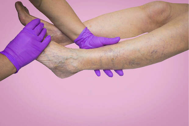 Назван способ остановить варикоз на ранней стадии