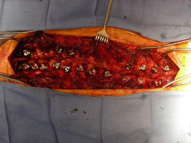 Сильная девушка до, во время и после операции на позвоночнике (14 фото)