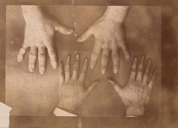 Руки человека с акромегалией по сравнению с руками обычного человека
